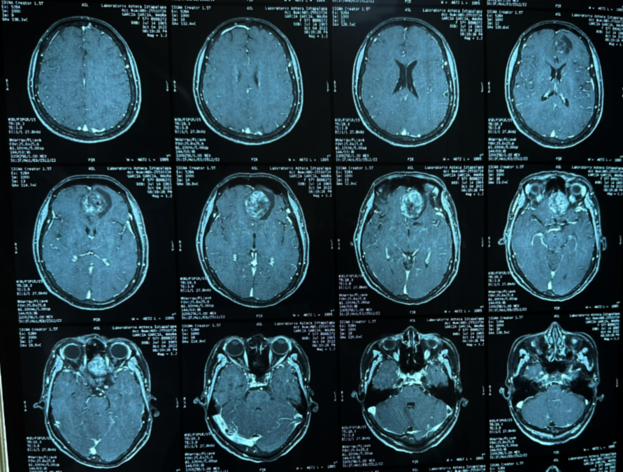 La comparación entre Gamma Knife y otras técnicas de radiocirugía un tema crucial