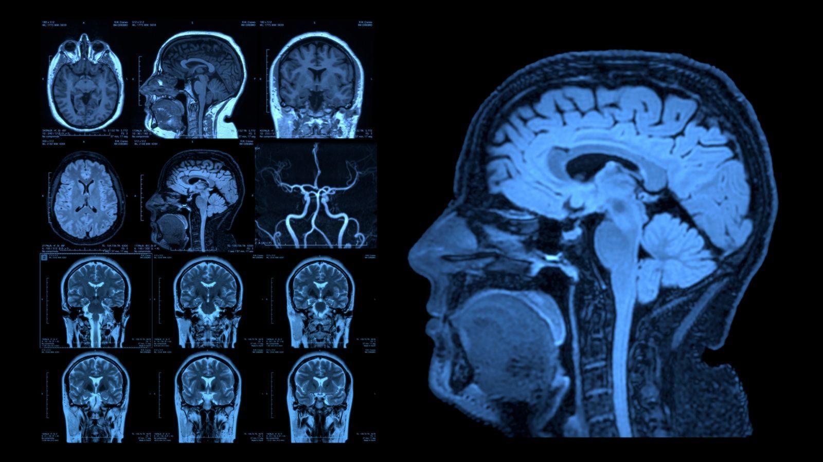 Una resonancia magnética de la cabeza y el cerebro de una persona.