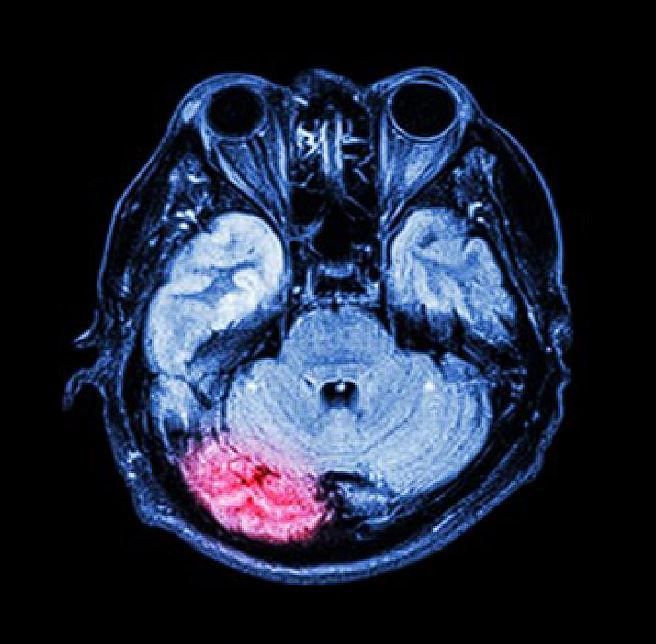 ¡Tumor Cerebral, soy el mejor Neurocirujano, con gusto te atiendo!