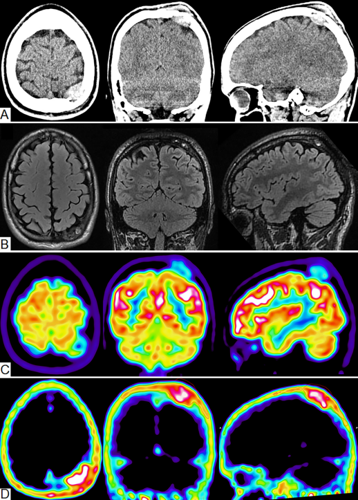 Un estudio publicado de Neurocirugía