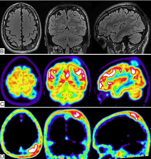 Se muestran tres imágenes del cerebro de una persona.
