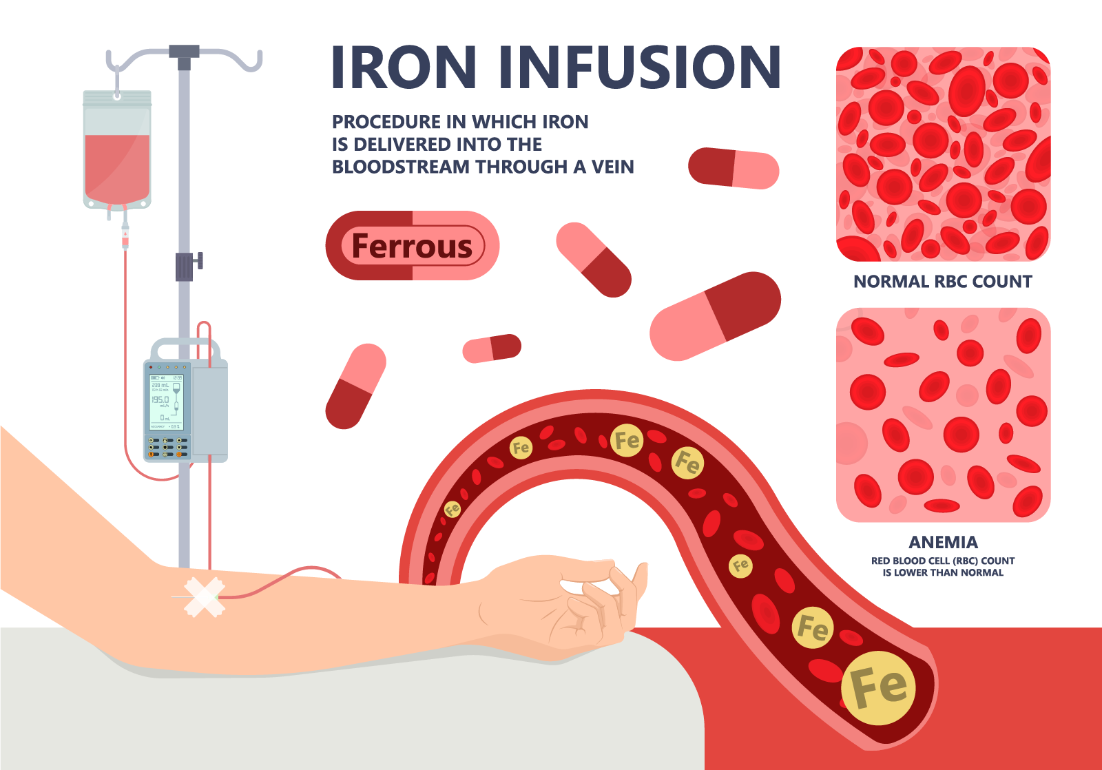 Iron Infusion | Somerton Park Day & Night Medical Centre