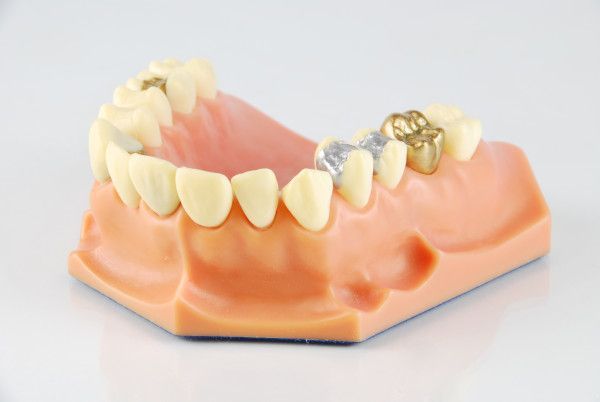 Modell eines Kiefers mit Goldkronen