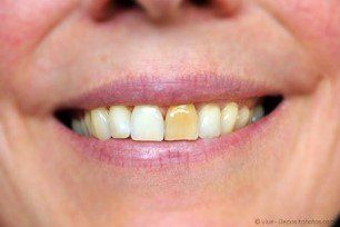 Auch einzelne Zähne können aufgehellt werden