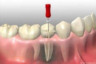 Wurzelbehandlung Berlin Neukölln