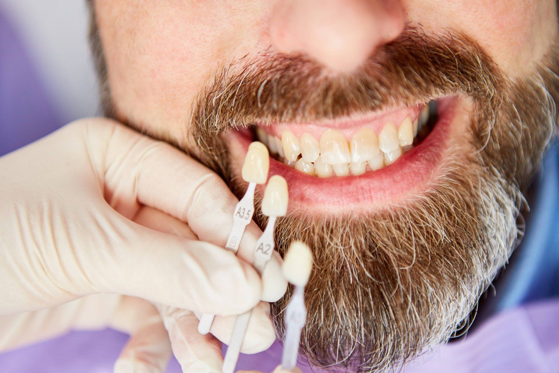 Mann mit Zahnverfärbung