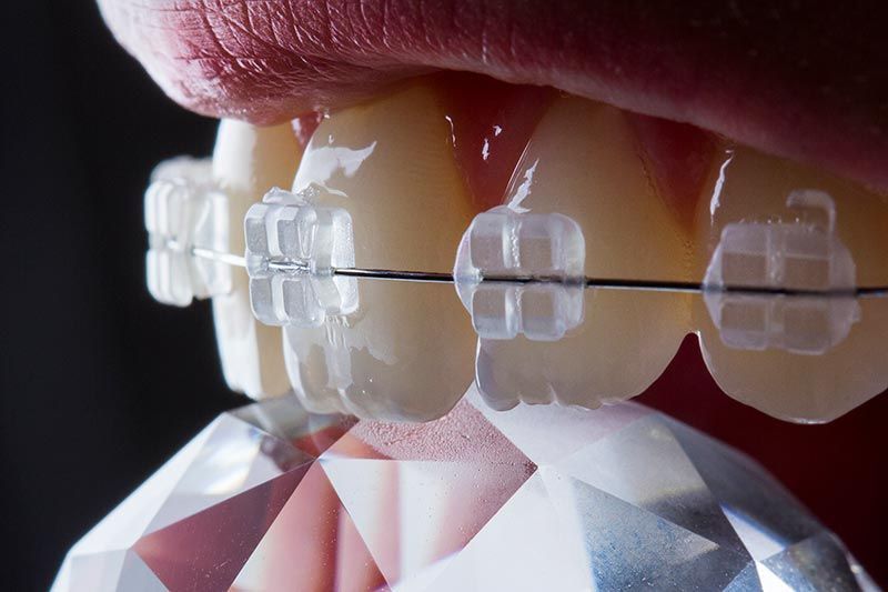 Un primer plano de los dientes de una persona con aparatos transparentes.