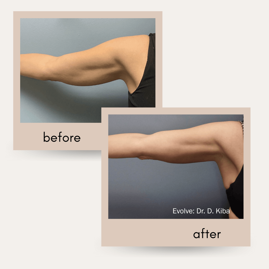 Evolve X transform before and after Arms