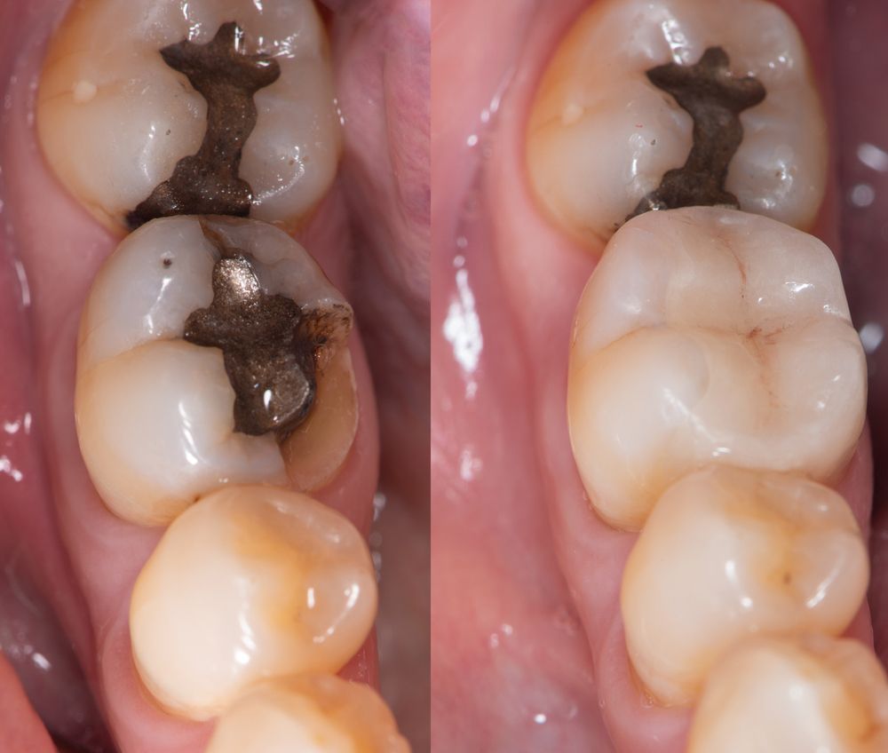 Teeth with dental fillings before and after treatment.