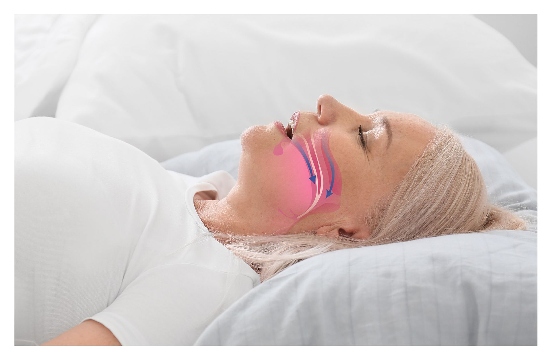 Woman sleeping in bed, illustrating airflow obstruction in pink, indicating snoring.
