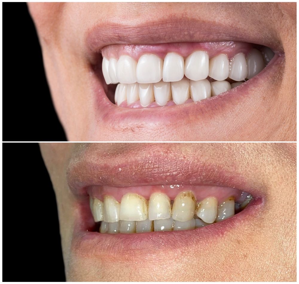 Avant et après le sourire d'une personne avec des dents nettement plus blanches. L'image du bas montre des dents décolorées.