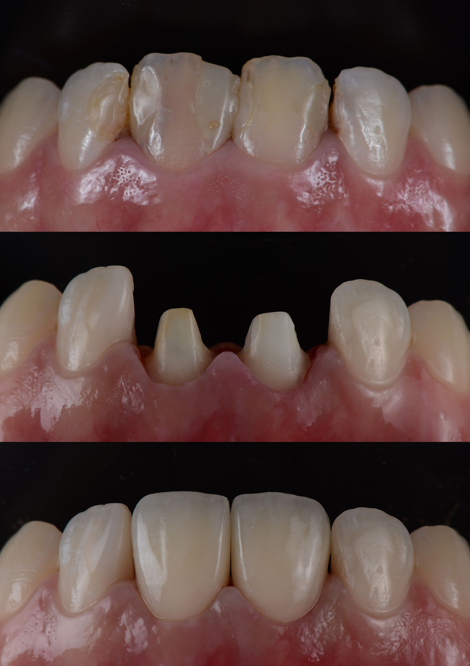 Dents : endommagées, préparées et restaurées pour créer un sourire complet.