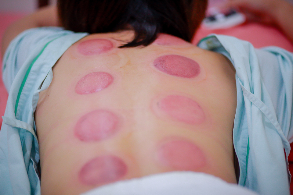 the entire experience of cupping therapy is generally relaxing and soothing