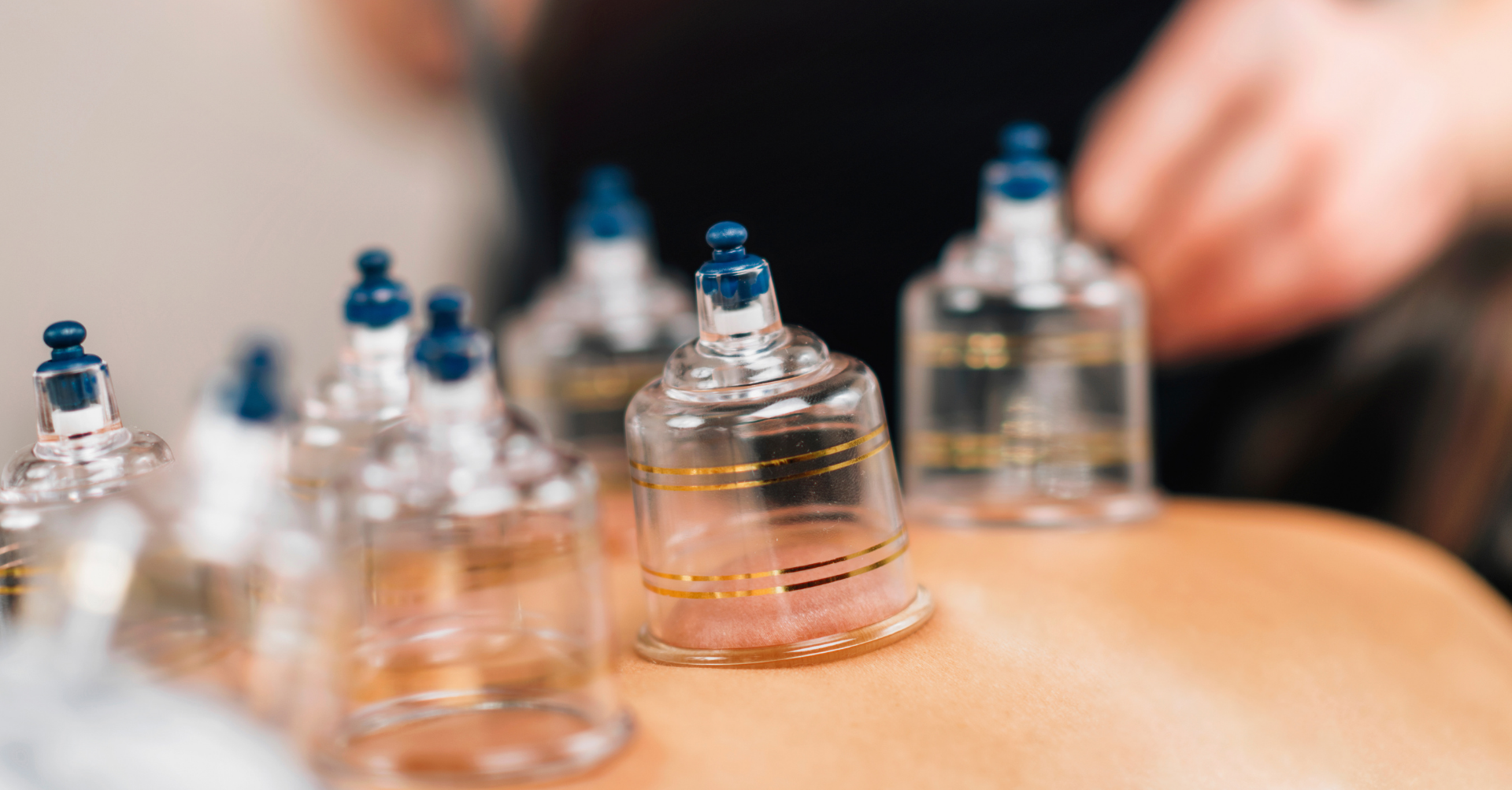 6 Things You Should Know About Cupping Therapy
