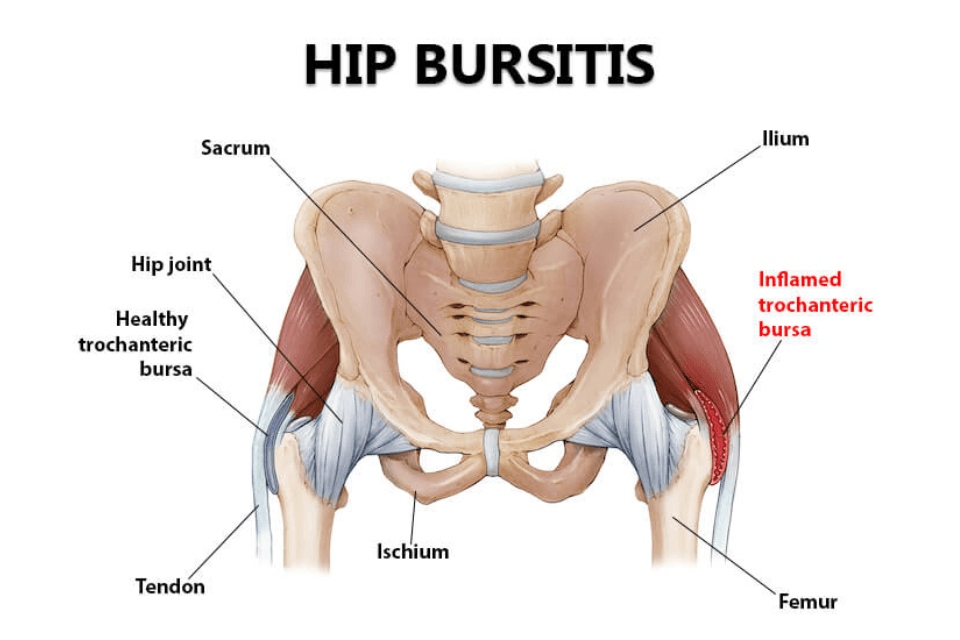 6 Common Causes of Hip Pain