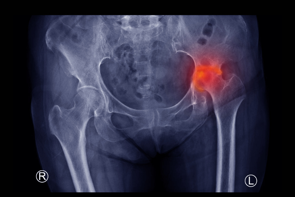 Advance Physicians treats hip pain in women.