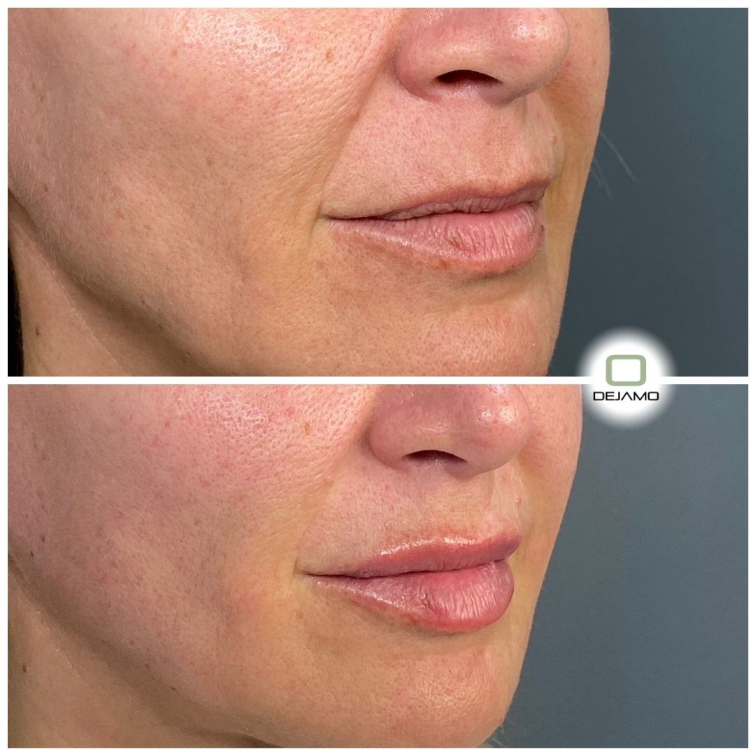 A before and after photo of a woman 's lips.