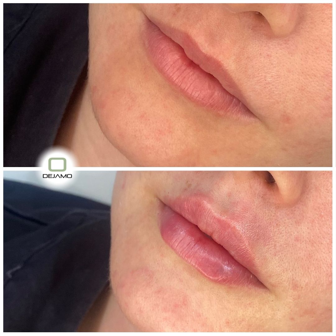 A before and after photo of a woman 's lips with the word screamer in the corner