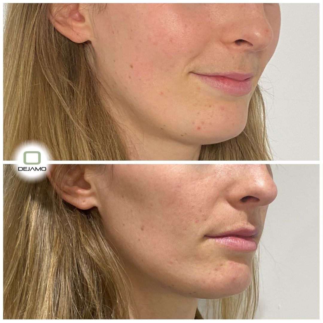 A before and after photo of a woman 's face.