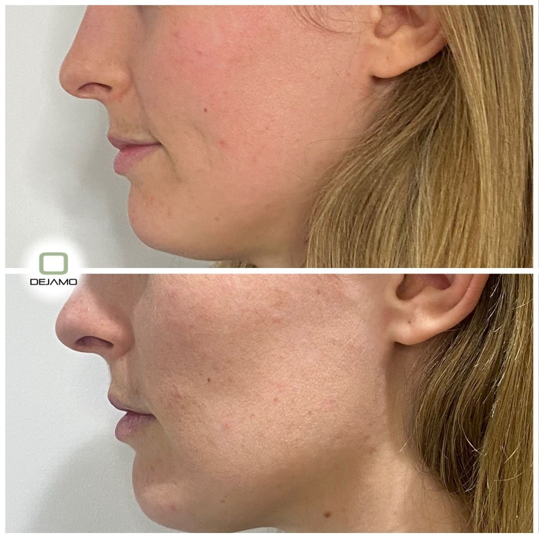 A before and after photo of a woman 's face