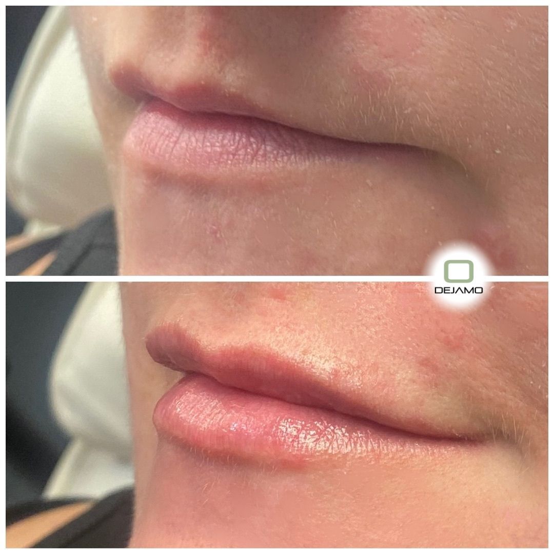 A before and after photo of a woman 's lips.