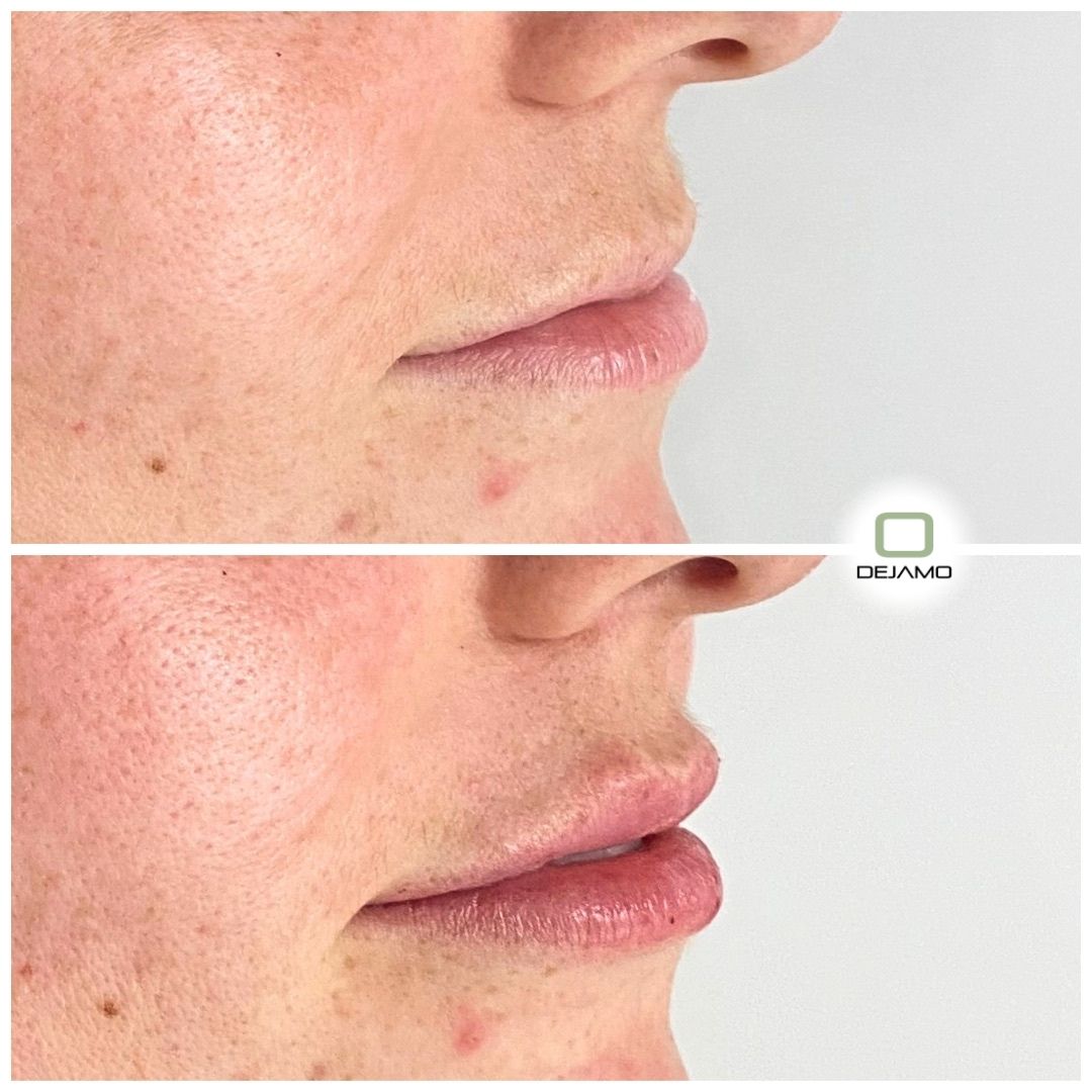A before and after photo of a woman 's lips.