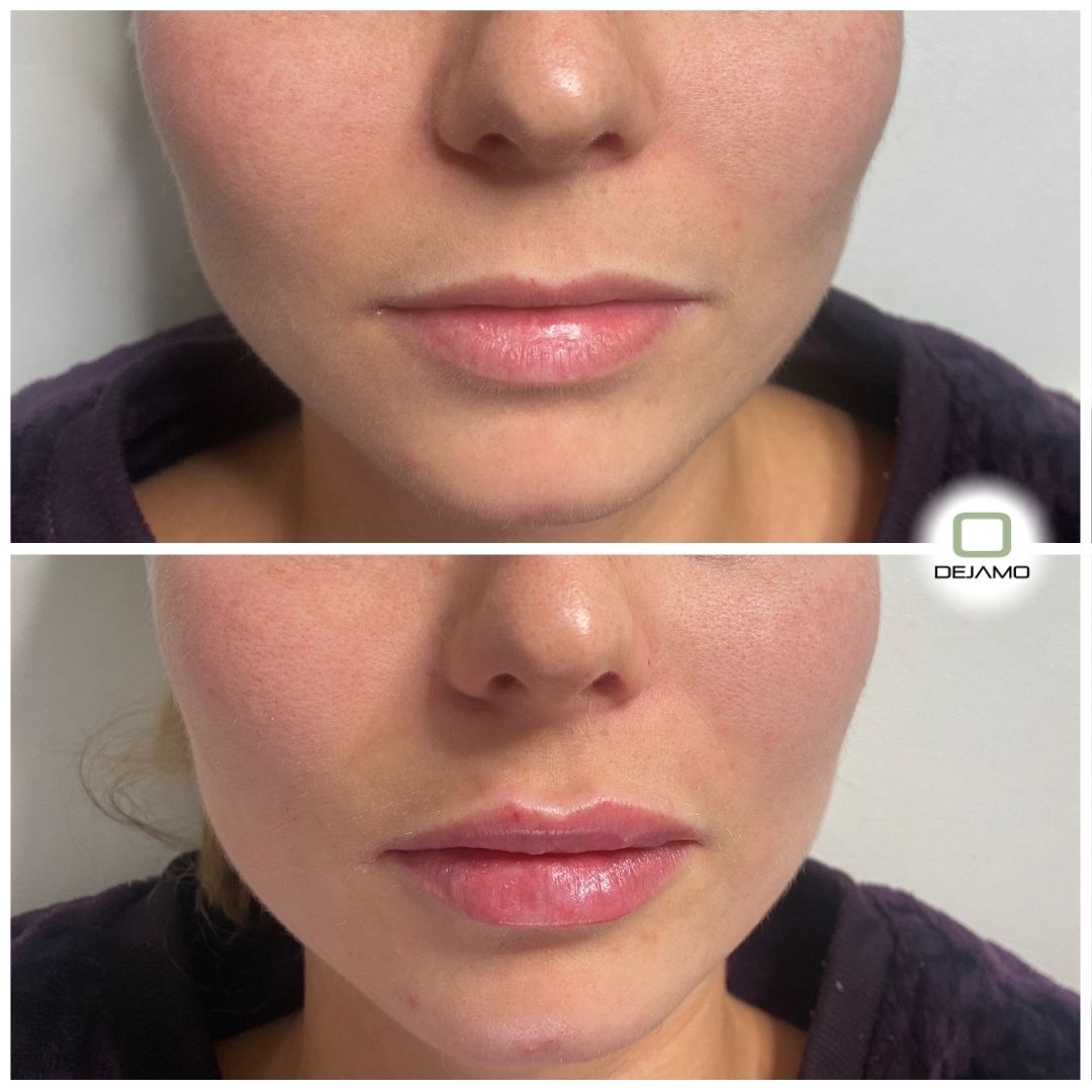 A before and after photo of a woman 's face