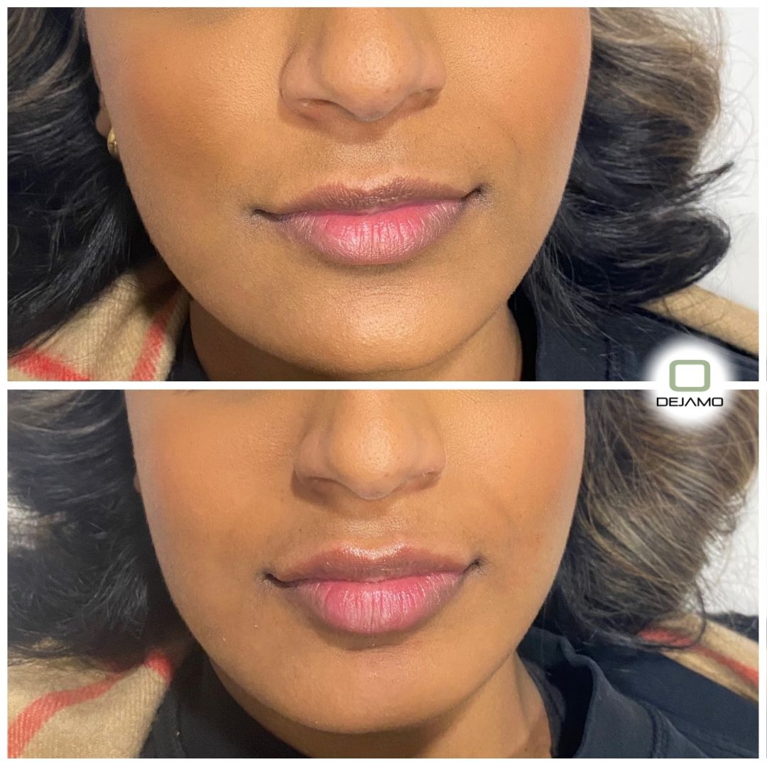 A before and after photo of a woman 's lips.