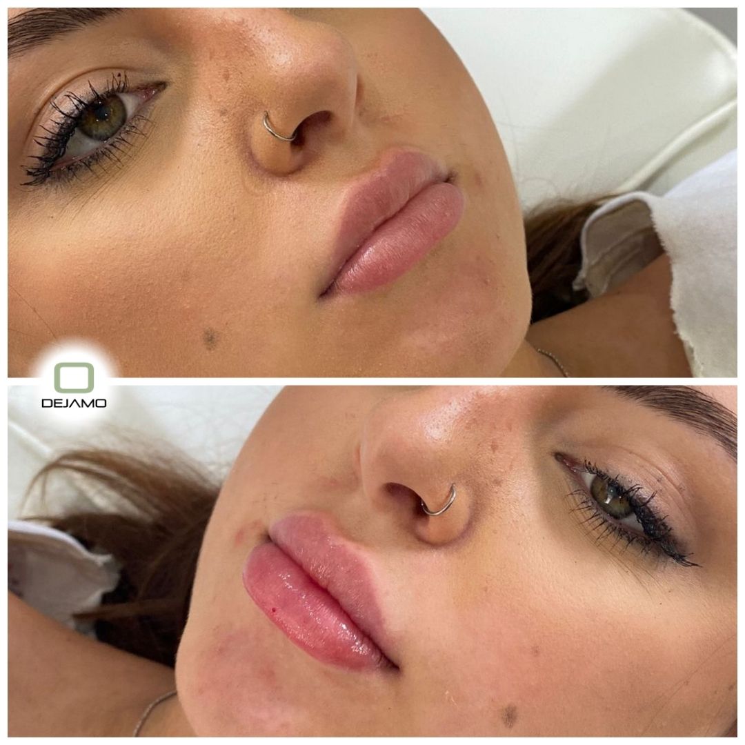 A before and after photo of a woman 's lips.