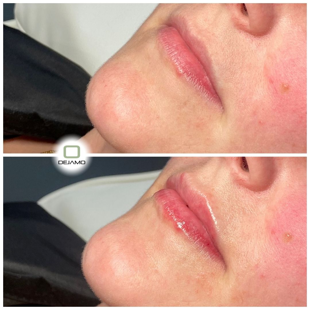 A before and after photo of a woman 's lips with the letter o in the corner