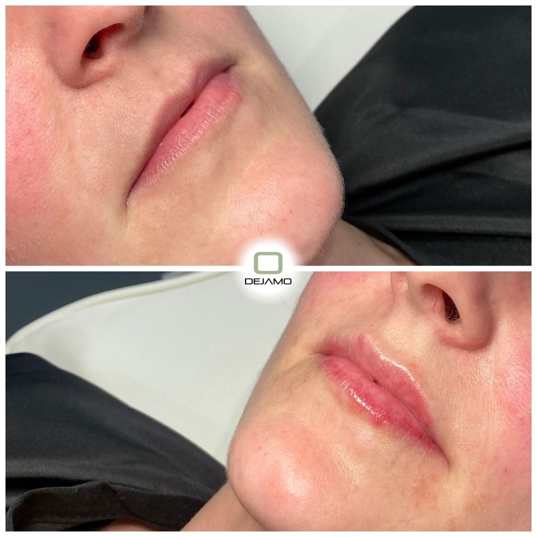 A before and after picture of a woman 's lips with the letter o in the corner