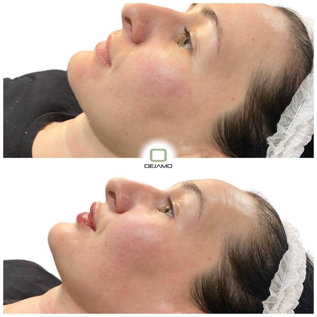 A before and after photo of a woman 's face