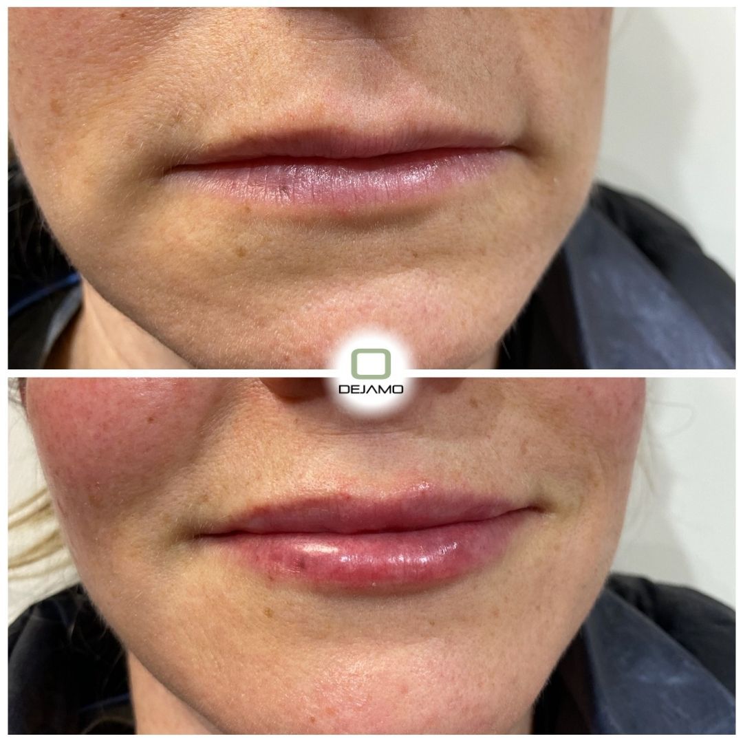 A before and after photo of a woman 's lips.