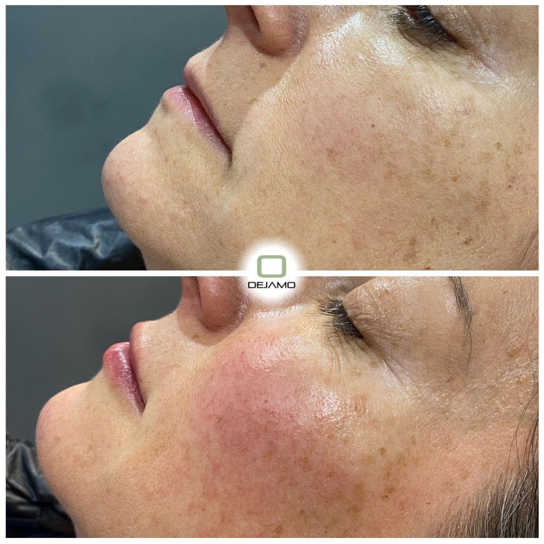 A before and after photo of a woman 's face.