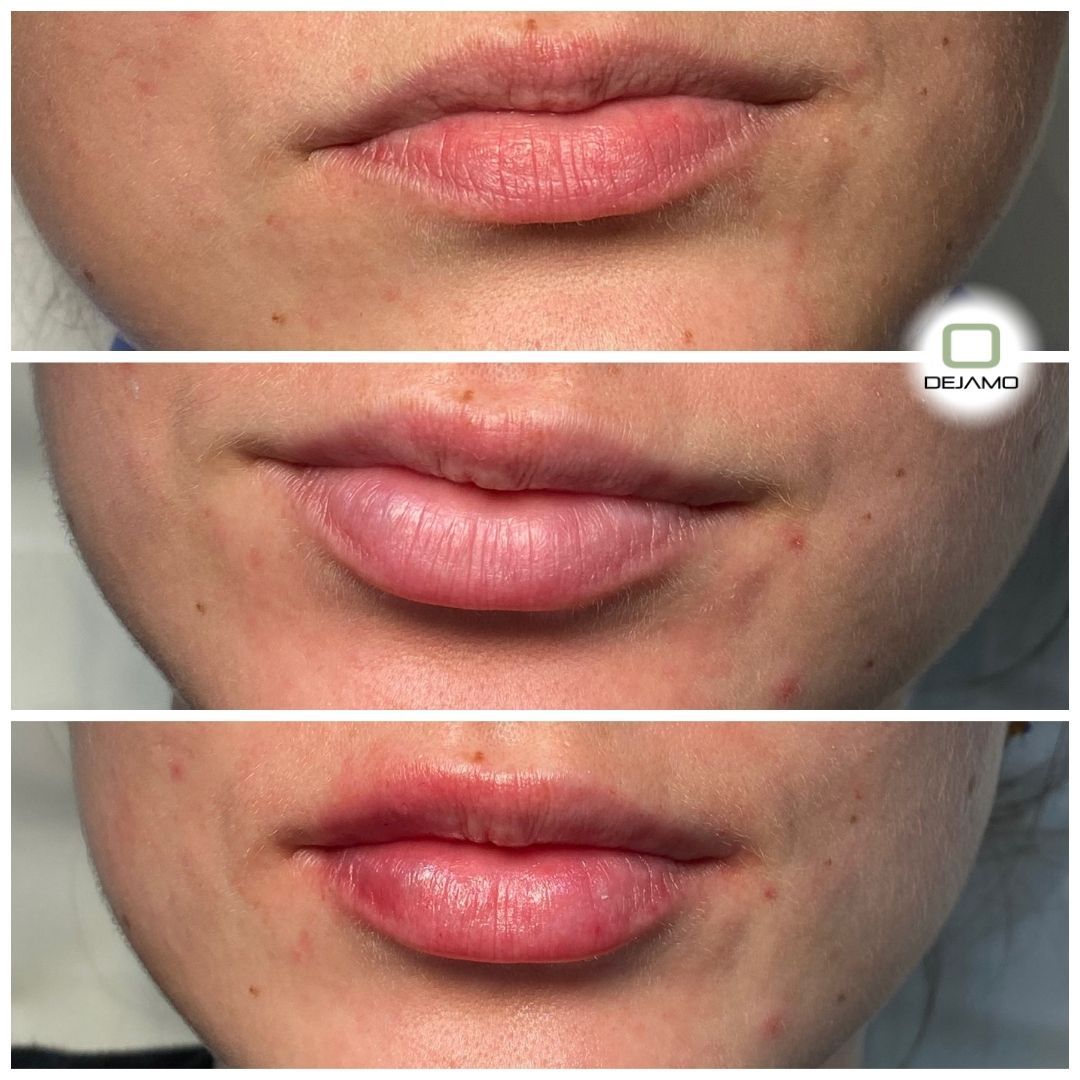 A before and after picture of a woman 's lips with the letter o in the corner