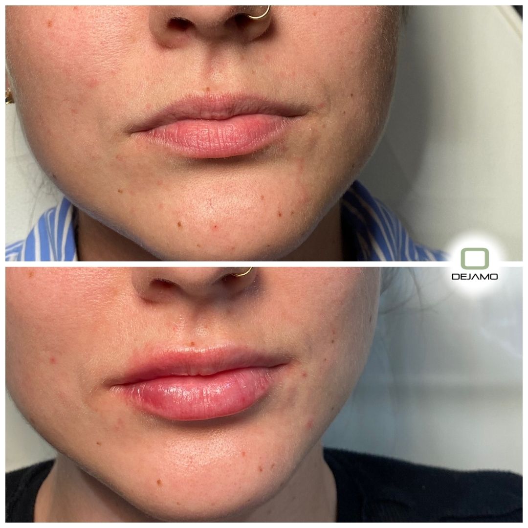 A before and after photo of a woman 's lips.