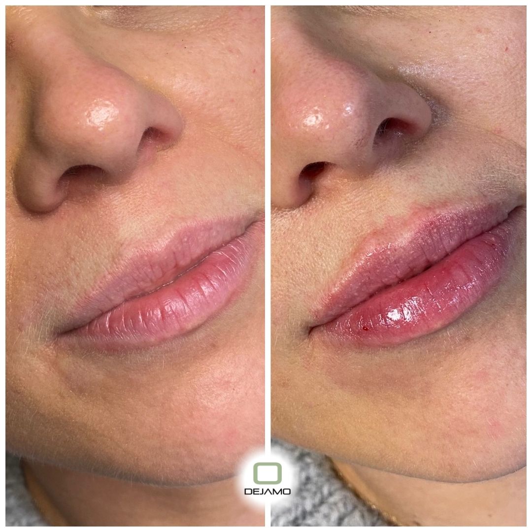 A before and after photo of a woman 's lips.