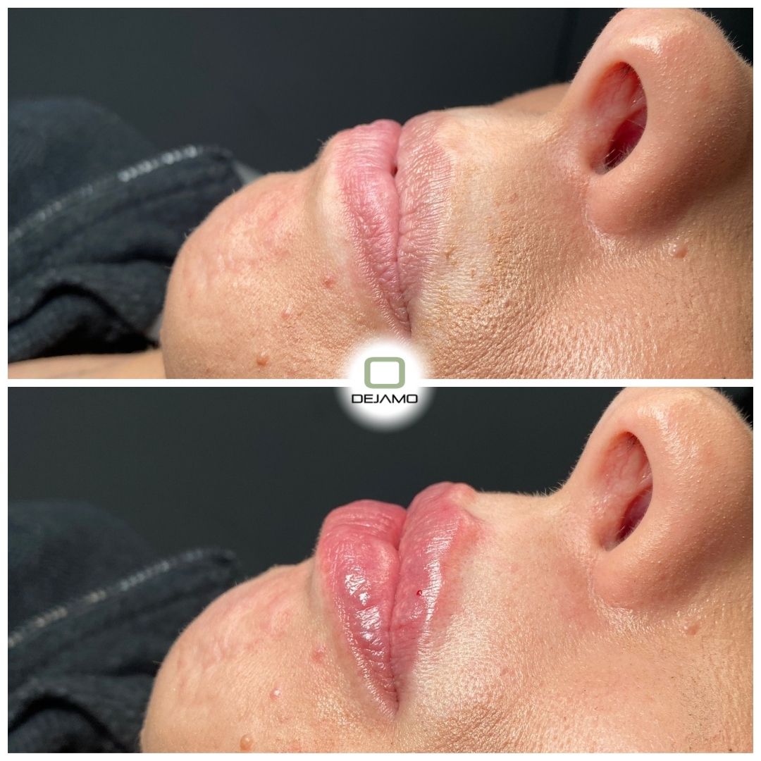 A before and after picture of a person 's lips