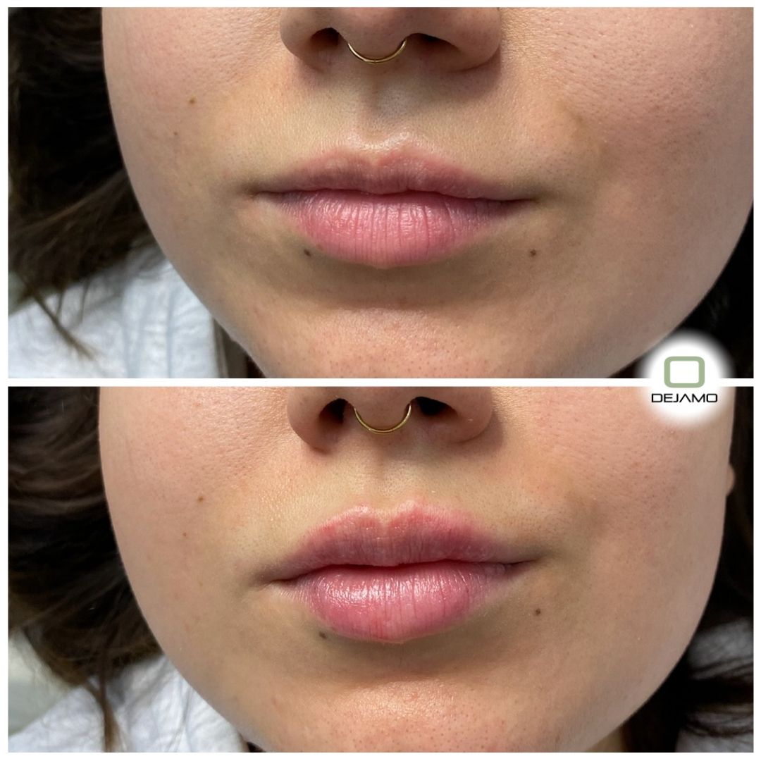 A before and after photo of a woman 's lips with a nose ring.