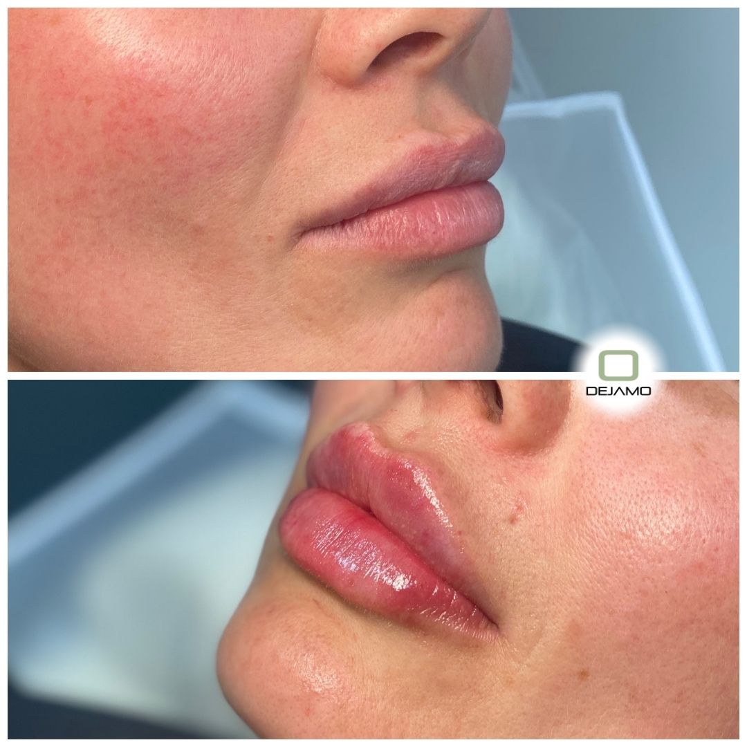 A before and after photo of a woman 's lips with the letter o in the corner