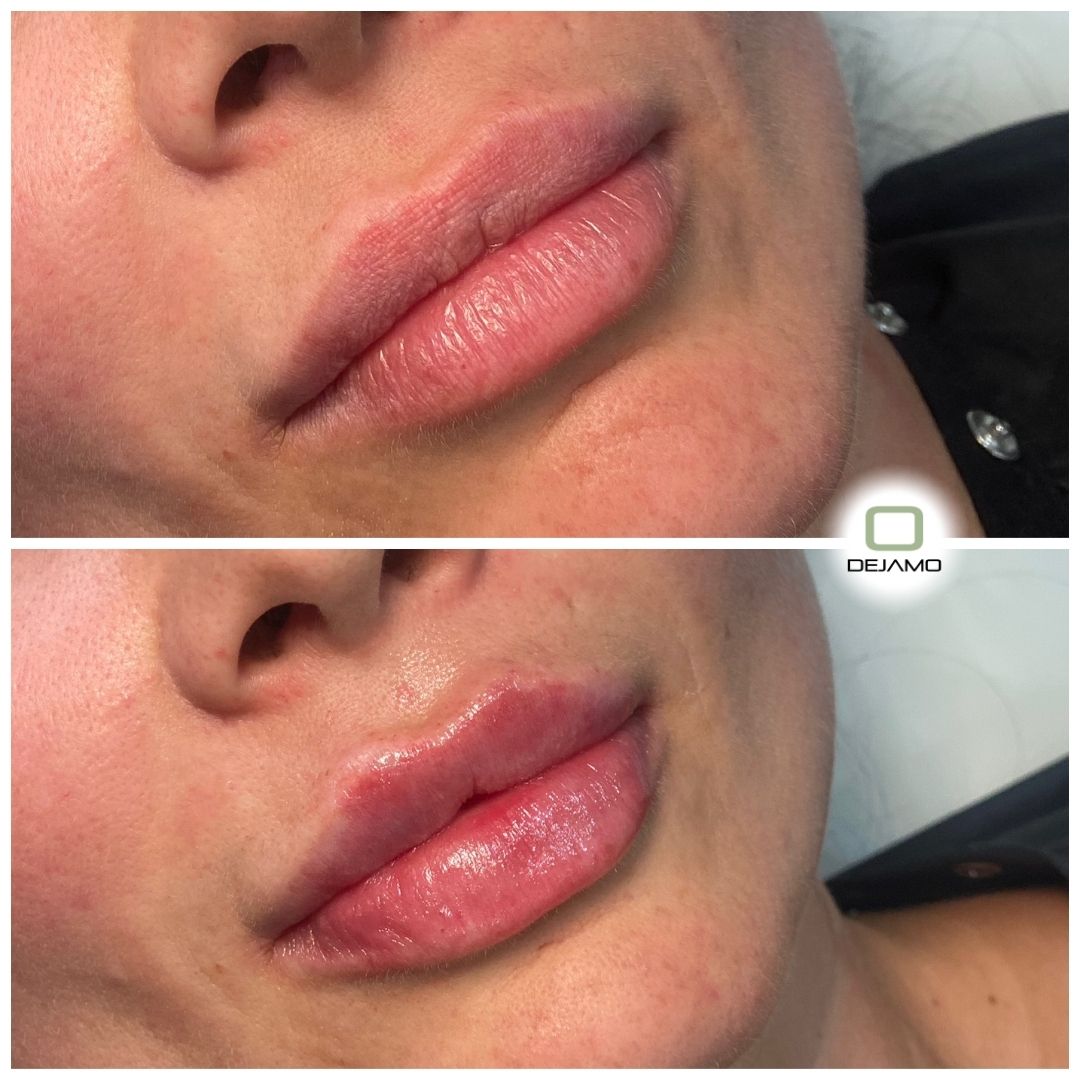 A before and after photo of a woman 's lips.