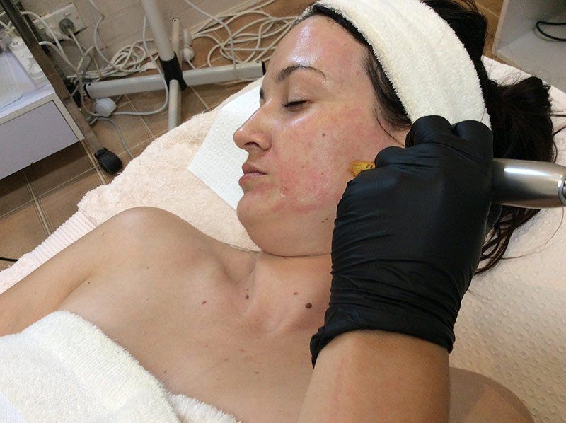 dermal needling skin treatment