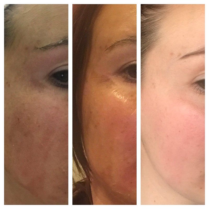 during and after RP peel for pigment