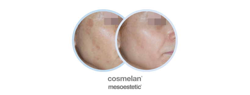 cosmelan treatment before and after