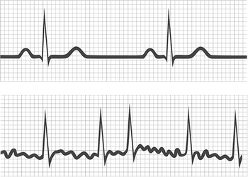 Normal heart rhythm vs atrial fibrillation