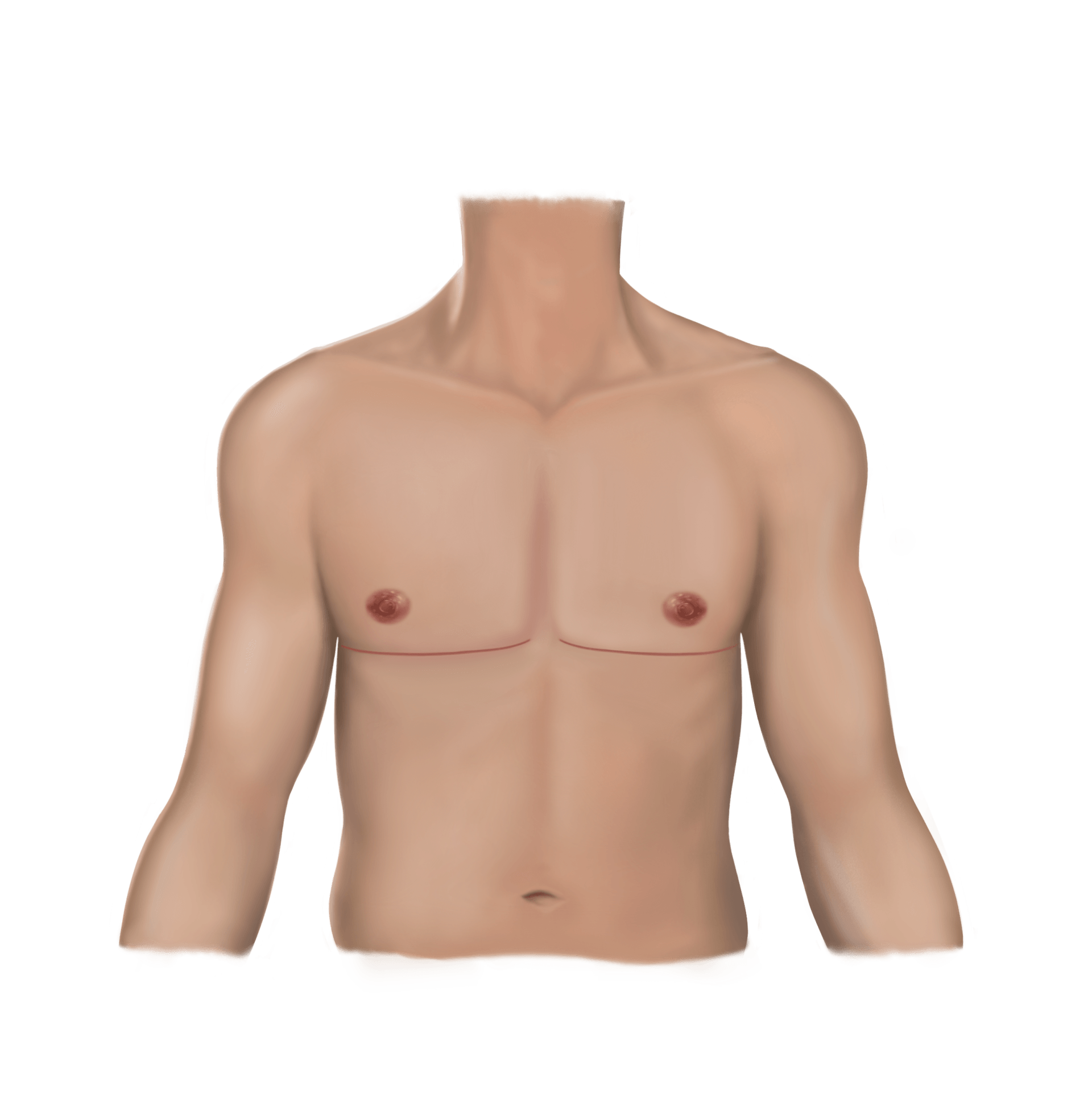 Double Incision-Post