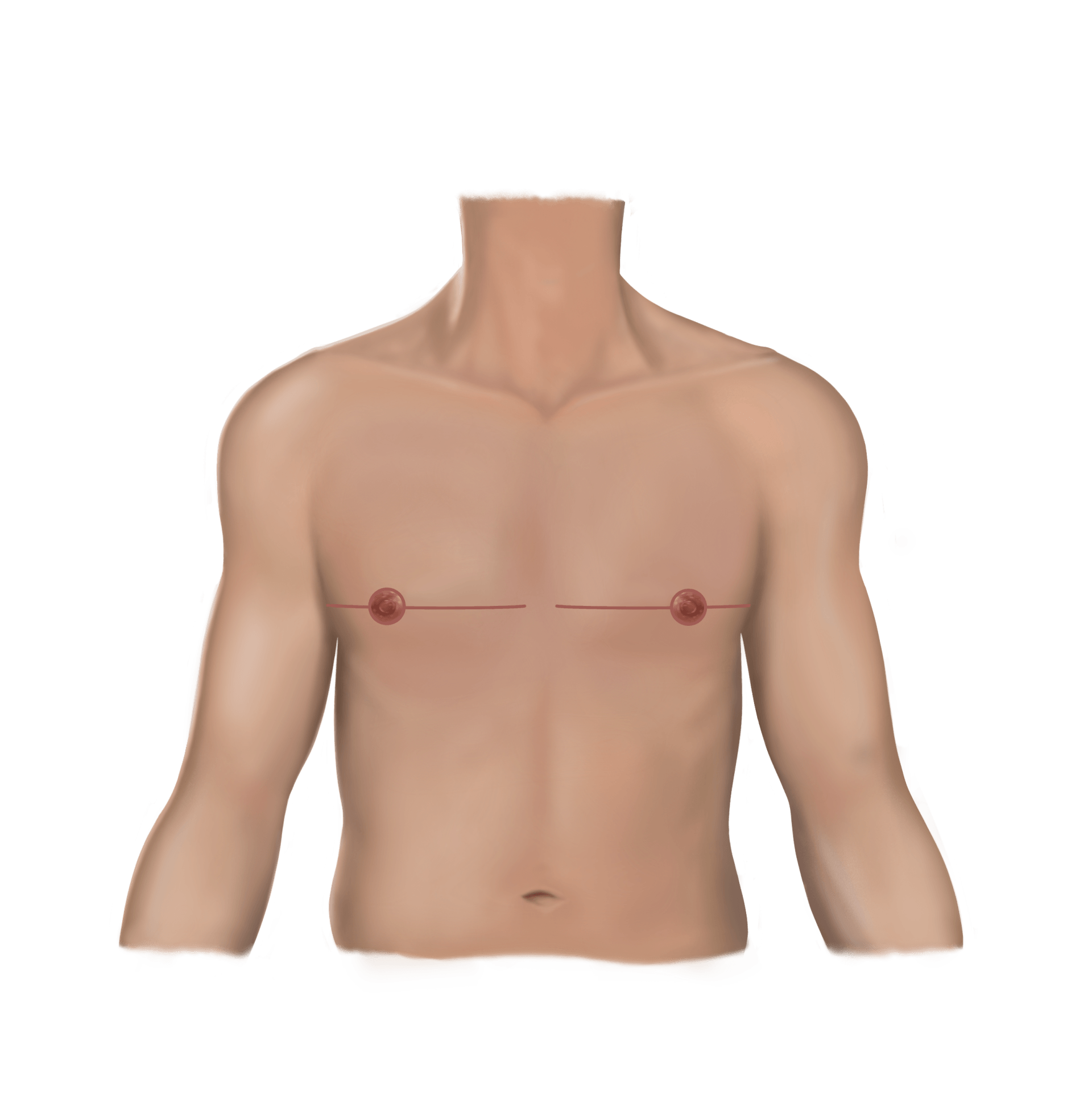 Fishmouth Incision Post
