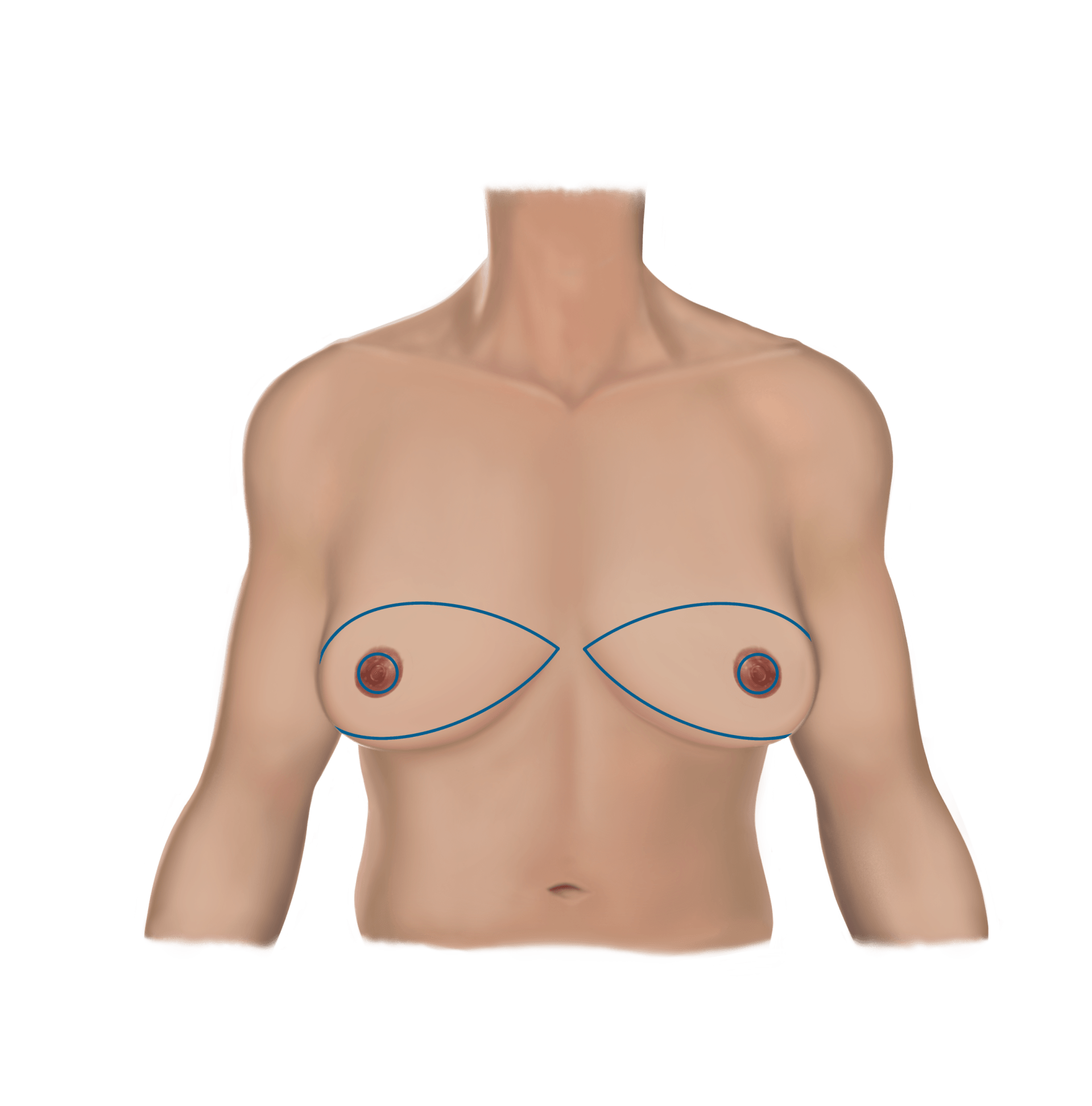 Fishmouth Incision Pre