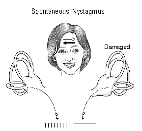 spontaneous nystagmus