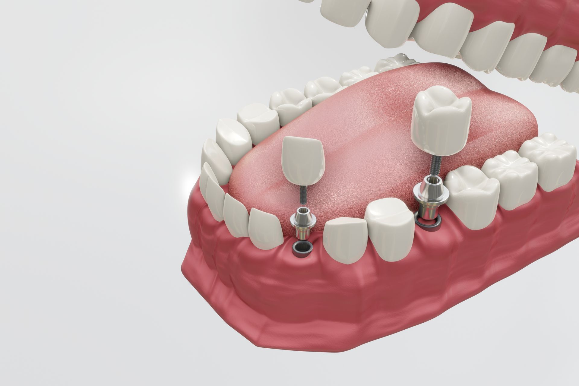 A model of a mouth with a dental implant in it.